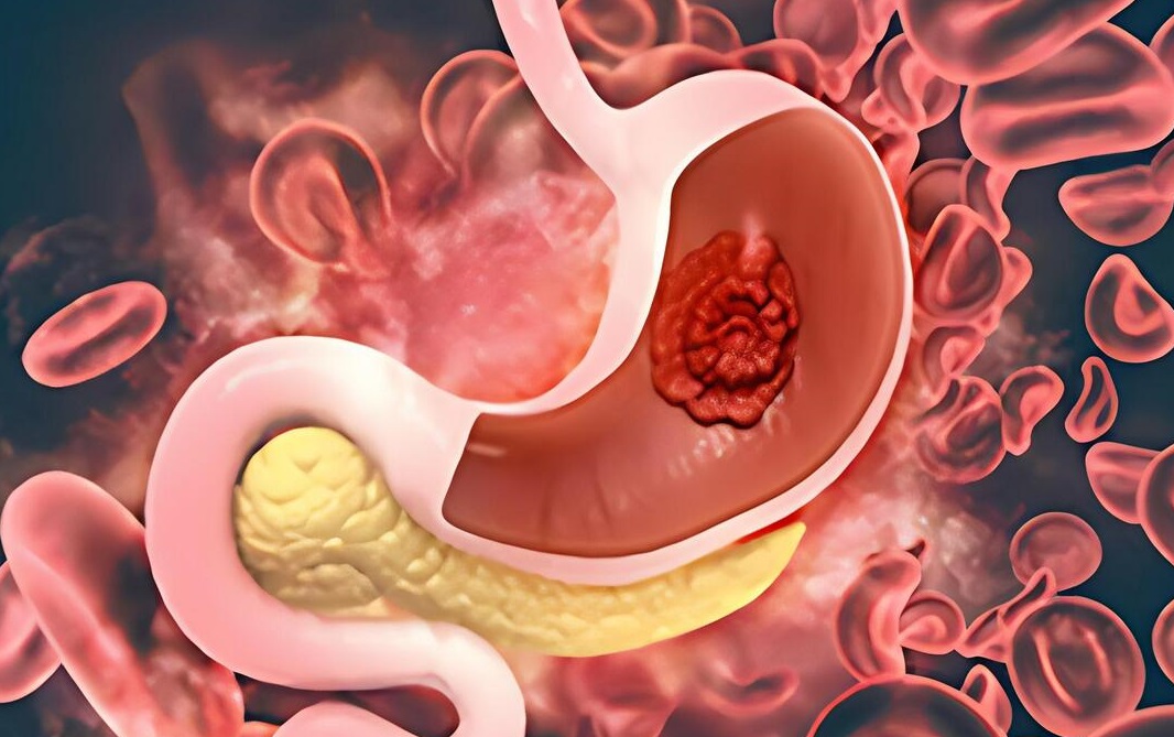 不想胃病拖成胃癌 提醒5个恶习趁早改掉