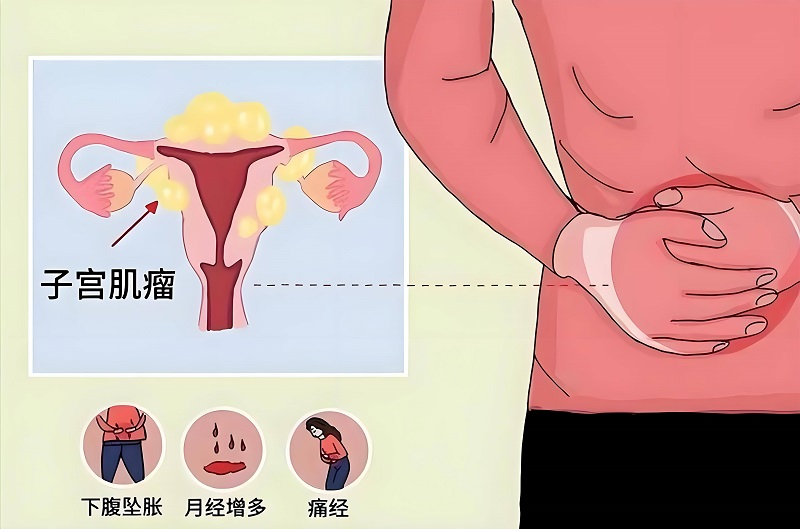 患上子宫肌瘤饮食需注意这三点 预防子宫肌瘤你得知道这些